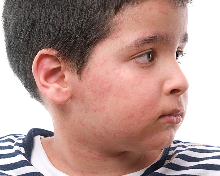 Image of a child with rash on their face